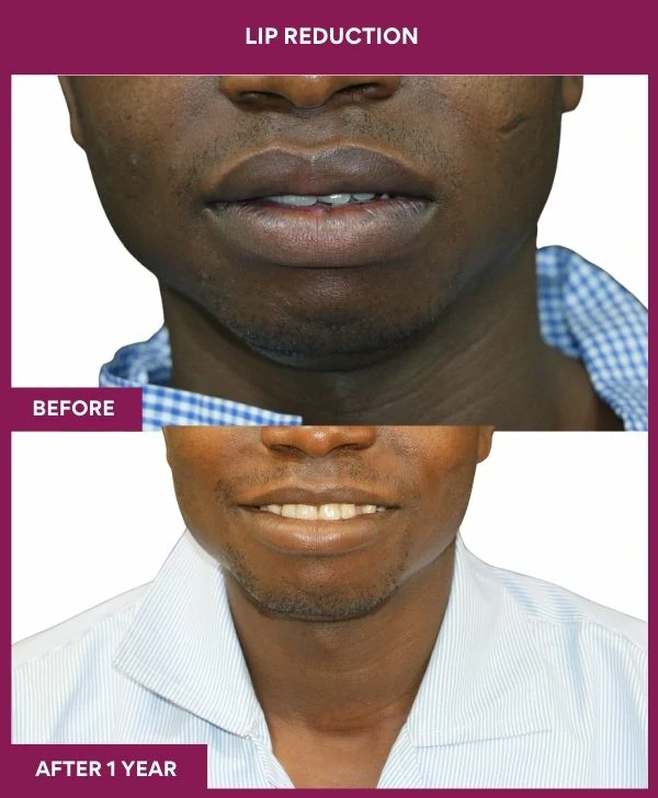 lip-reduction-surgery-before-after-results-mumbai-india-patient09-front