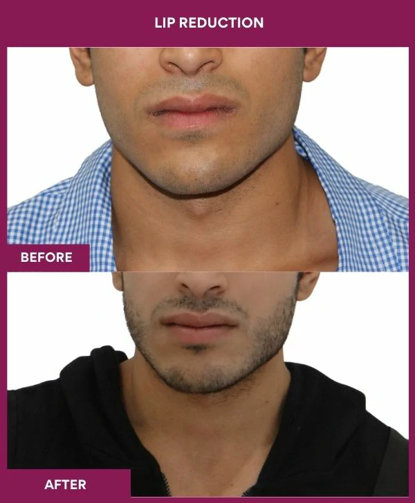 lip-reduction-surgery-before-after-results-mumbai-india-patient10-front