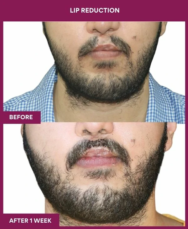 lip-reduction-surgery-before-after-results-mumbai-india-patient11-front