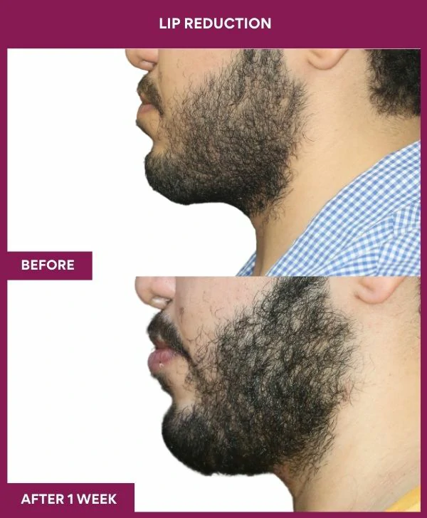 lip-reduction-surgery-before-after-results-mumbai-india-patient11-side-left