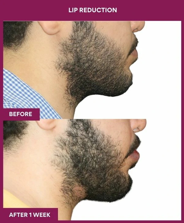lip-reduction-surgery-before-after-results-mumbai-india-patient11-side-right