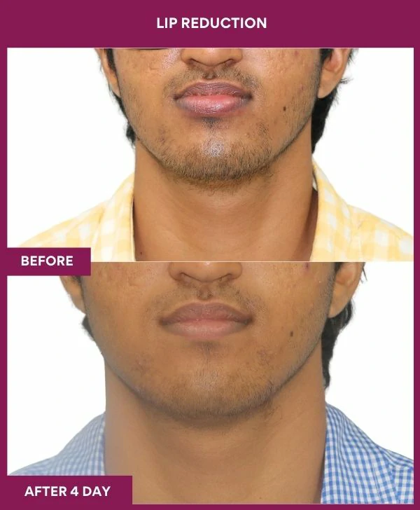 lip-reduction-surgery-before-after-results-mumbai-india-patient12-front