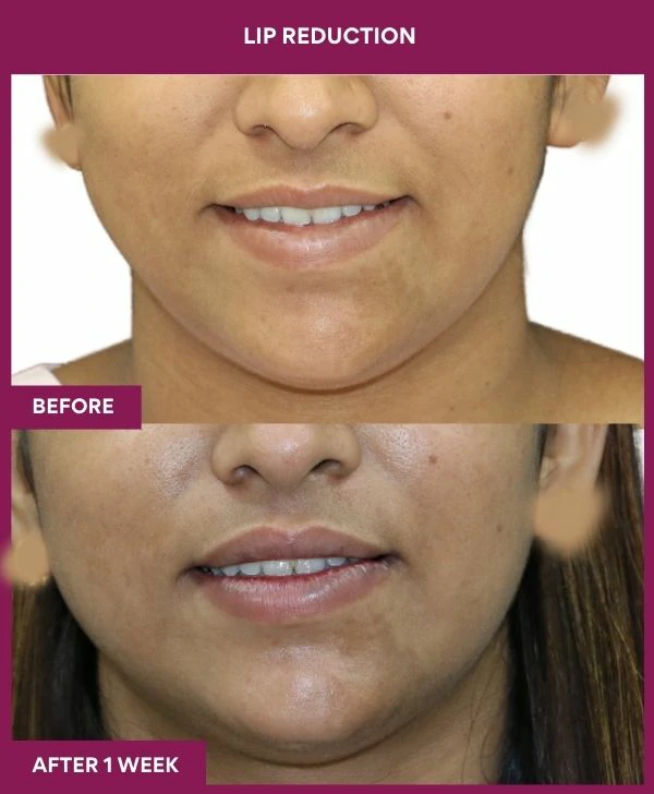 lip-reduction-surgery-before-after-results-mumbai-india-patient13-front