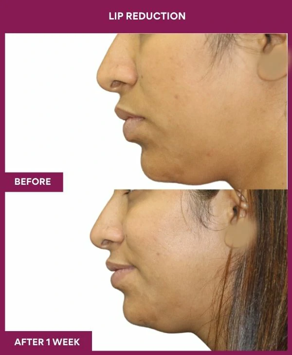 lip-reduction-surgery-before-after-results-mumbai-india-patient13-side-left