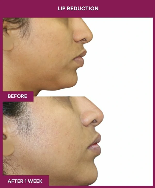 lip-reduction-surgery-before-after-results-mumbai-india-patient13-side-right