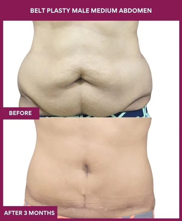 male-belt-lipectomy-before-after-results-mumbai-india-patient01-front