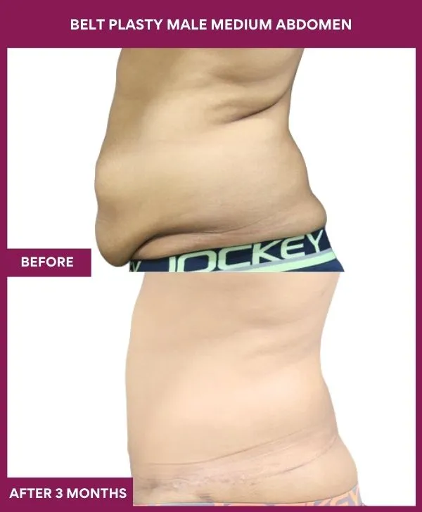 male-belt-lipectomy-before-after-results-mumbai-india-patient01-side-left