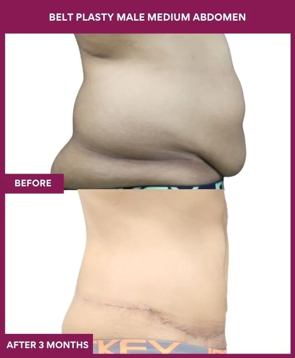 male-belt-lipectomy-before-after-results-mumbai-india-patient01-side-right