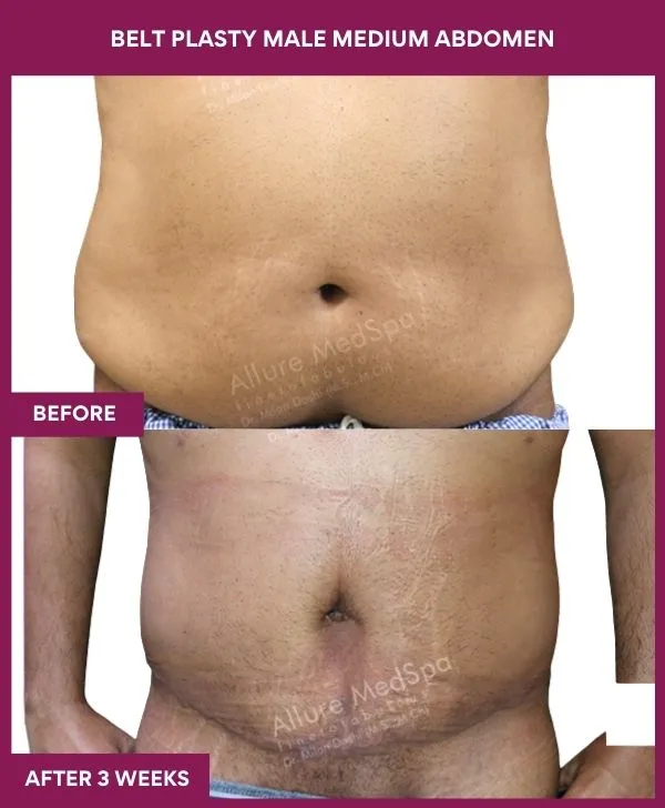 male-belt-lipectomy-before-after-results-mumbai-india-patient02-front