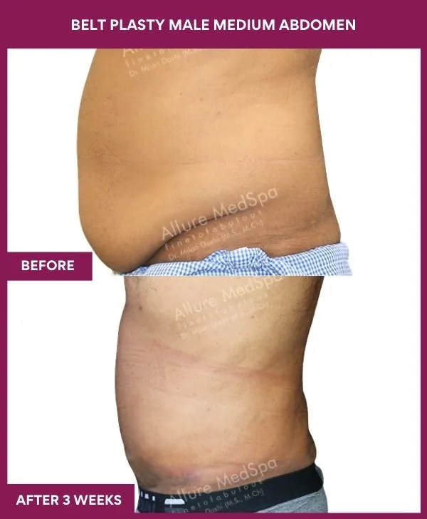 male-belt-lipectomy-before-after-results-mumbai-india-patient02-side-left