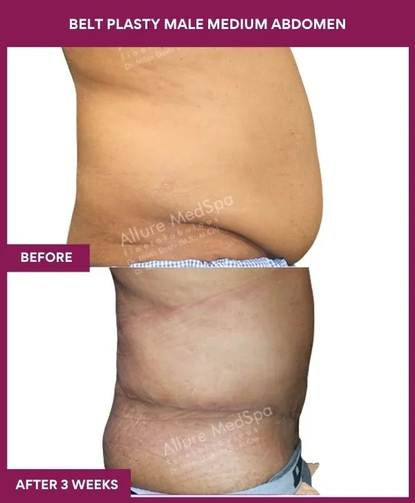 male-belt-lipectomy-before-after-results-mumbai-india-patient02-side-right