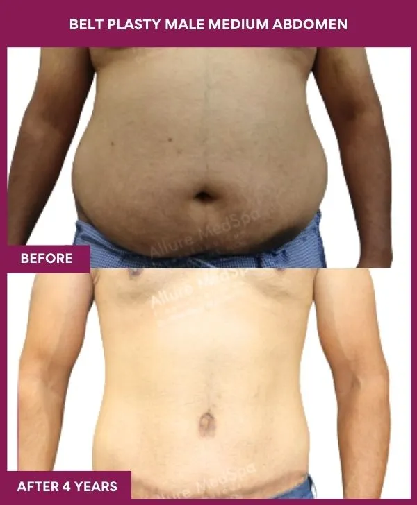 male-belt-lipectomy-before-after-results-mumbai-india-patient03-front