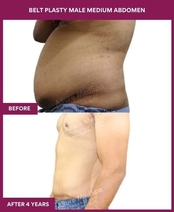 male-belt-lipectomy-before-after-results-mumbai-india-patient03-side-left