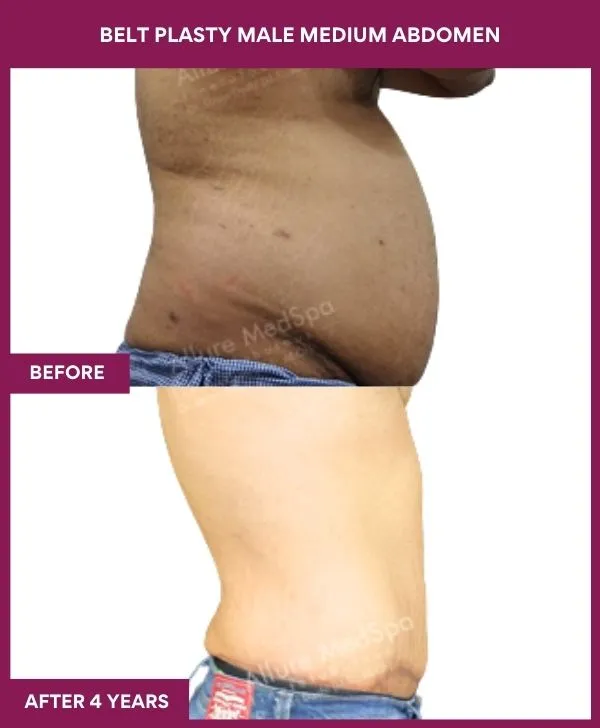 male-belt-lipectomy-before-after-results-mumbai-india-patient03-side-right
