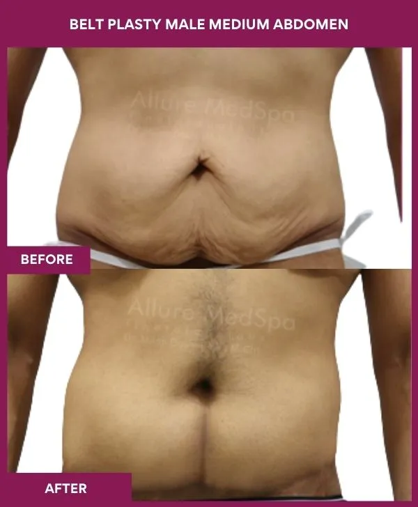 male-belt-lipectomy-before-after-results-mumbai-india-patient04-front