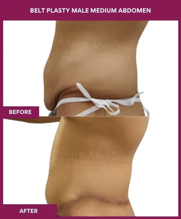 male-belt-lipectomy-before-after-results-mumbai-india-patient04-side-left