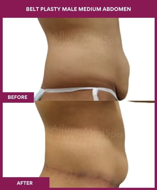 male-belt-lipectomy-before-after-results-mumbai-india-patient04-side-right
