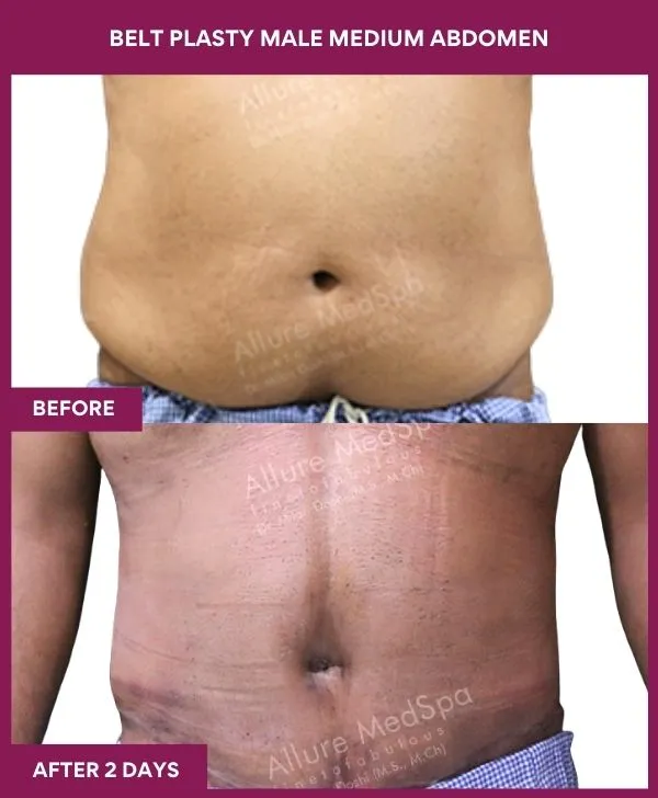 male-belt-lipectomy-before-after-results-mumbai-india-patient05-front