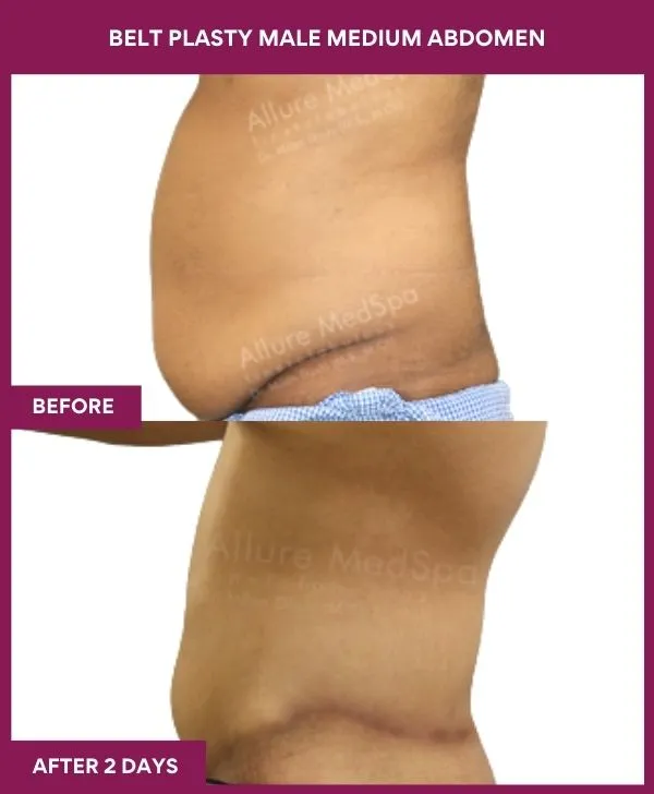 male-belt-lipectomy-before-after-results-mumbai-india-patient05-side-left