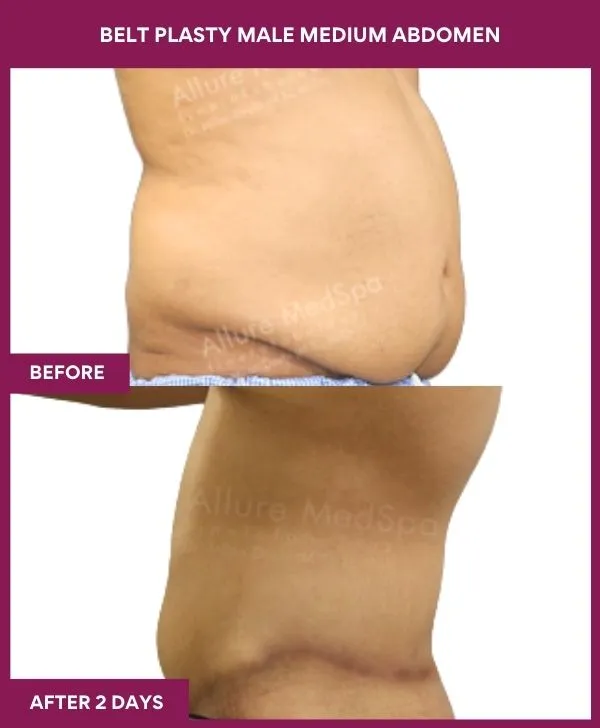 male-belt-lipectomy-before-after-results-mumbai-india-patient05-side-right