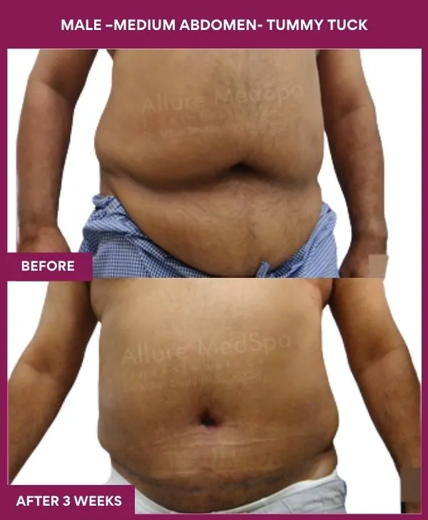 male-medium-tummy-tuck-before-after-results-mumbai-india-patient01-front