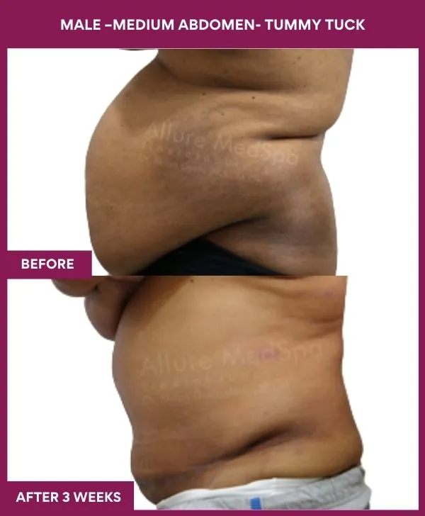 male-medium-tummy-tuck-before-after-results-mumbai-india-patient01-side-left