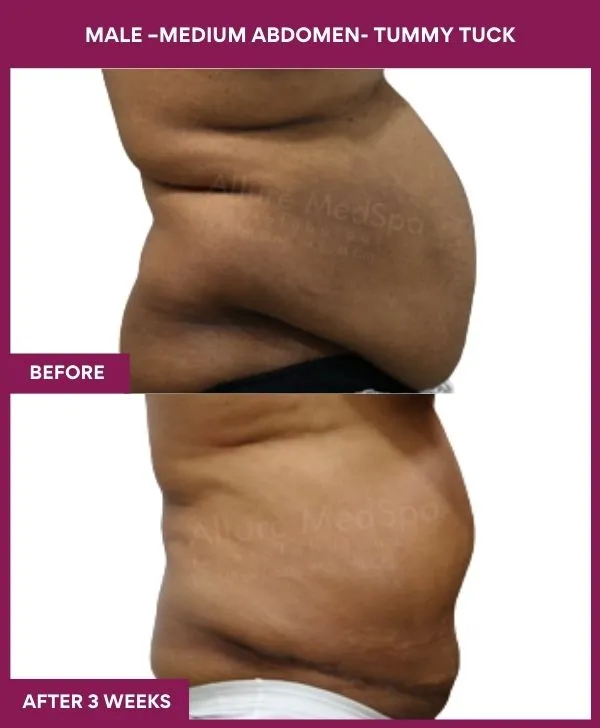 male-medium-tummy-tuck-before-after-results-mumbai-india-patient01-side-right