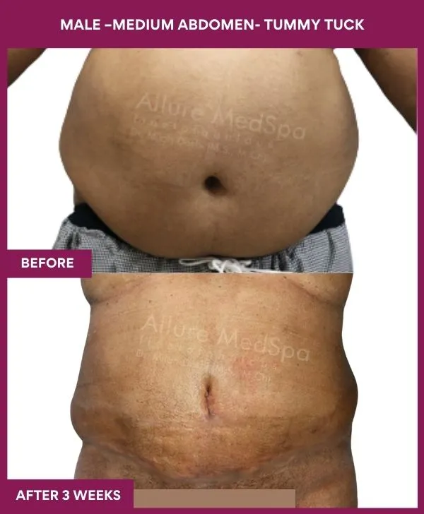 male-medium-tummy-tuck-before-after-results-mumbai-india-patient02-front