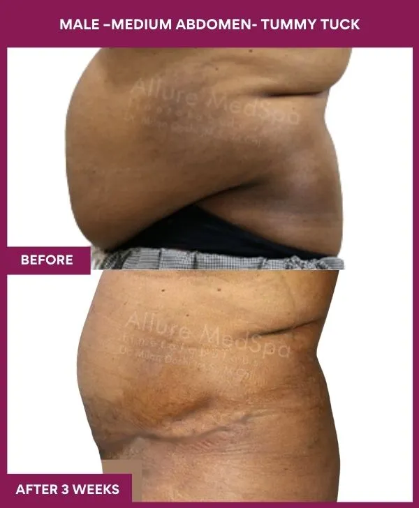 male-medium-tummy-tuck-before-after-results-mumbai-india-patient02-side-left