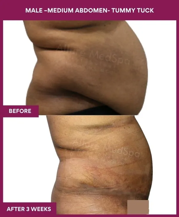 male-medium-tummy-tuck-before-after-results-mumbai-india-patient02-side-right