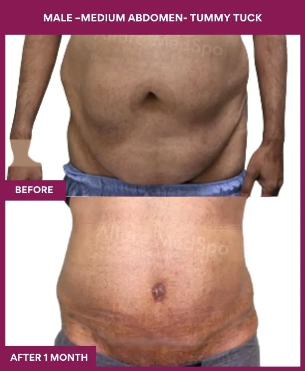 male-medium-tummy-tuck-before-after-results-mumbai-india-patient03-front