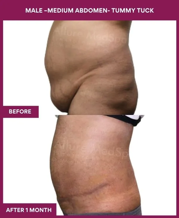 male-medium-tummy-tuck-before-after-results-mumbai-india-patient03-side-left