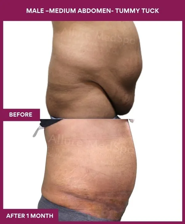 male-medium-tummy-tuck-before-after-results-mumbai-india-patient03-side-right