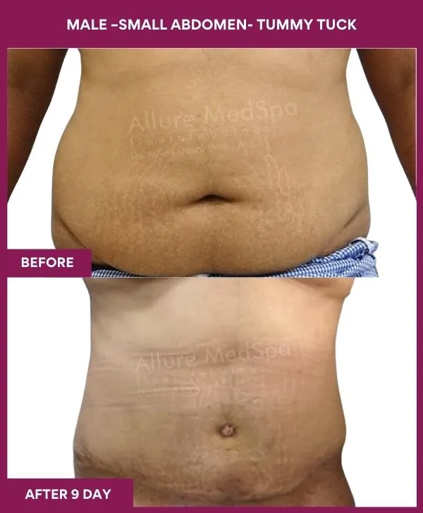 male-small-tummy-tuck-before-after-results-mumbai-india-patient01-side-front