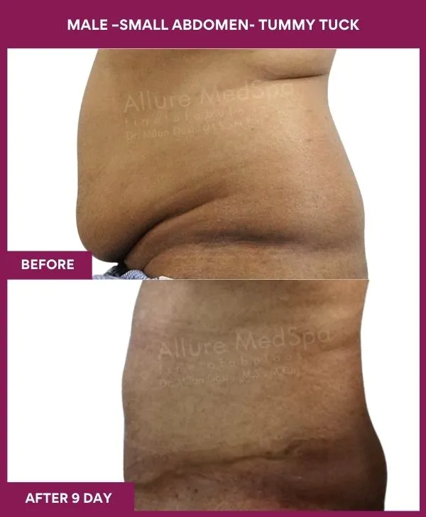 male-small-tummy-tuck-before-after-results-mumbai-india-patient01-side-left