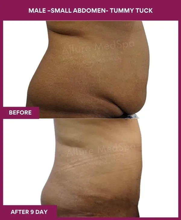 male-small-tummy-tuck-before-after-results-mumbai-india-patient01-side-right