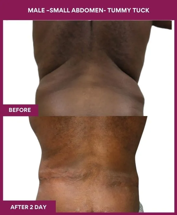 male-small-tummy-tuck-before-after-results-mumbai-india-patient02-back