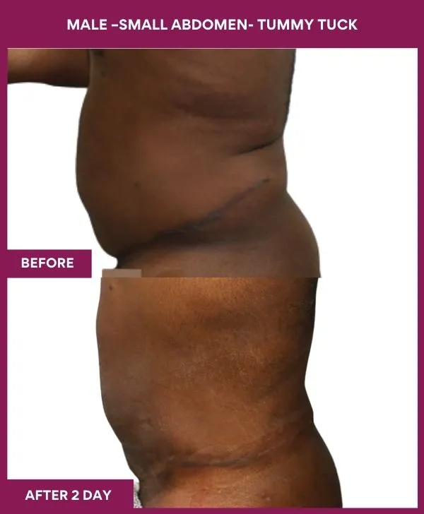 male-small-tummy-tuck-before-after-results-mumbai-india-patient02-side-left
