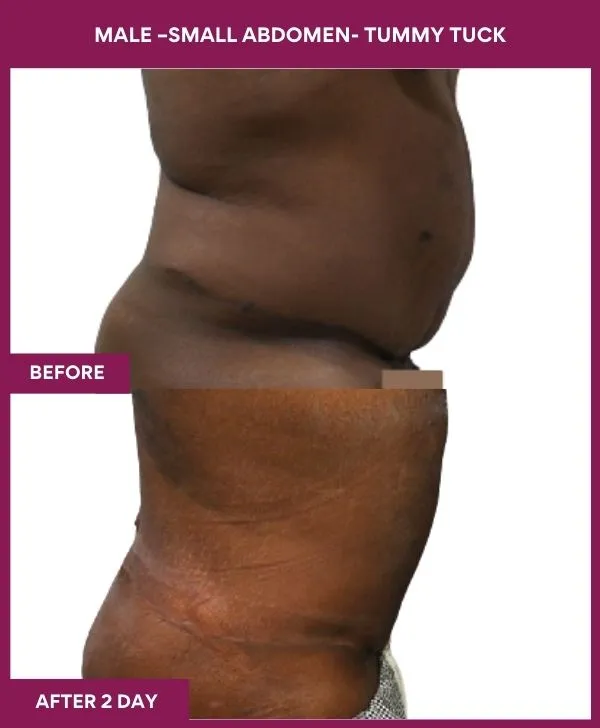 male-small-tummy-tuck-before-after-results-mumbai-india-patient02-side-right