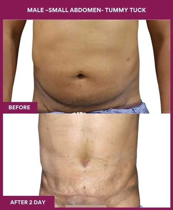 male-small-tummy-tuck-before-after-results-mumbai-india-patient03-front