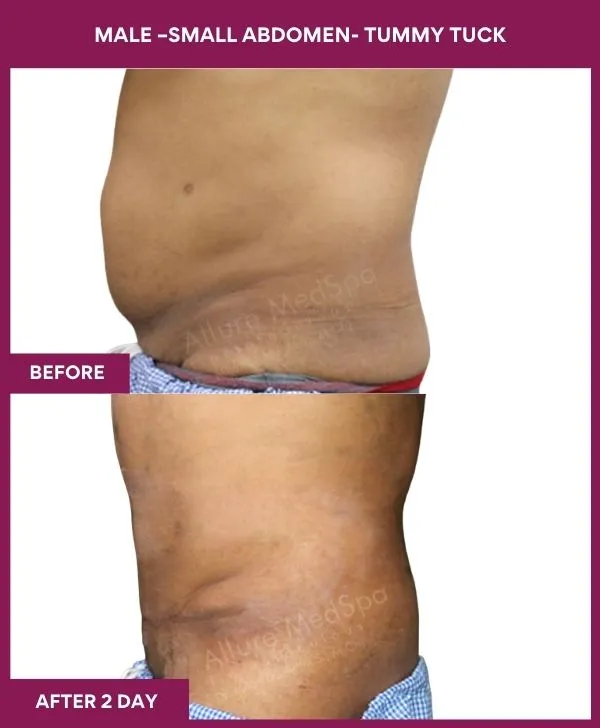 male-small-tummy-tuck-before-after-results-mumbai-india-patient03-side-left