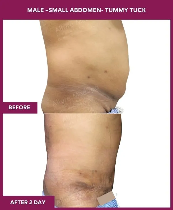 male-small-tummy-tuck-before-after-results-mumbai-india-patient03-side-right