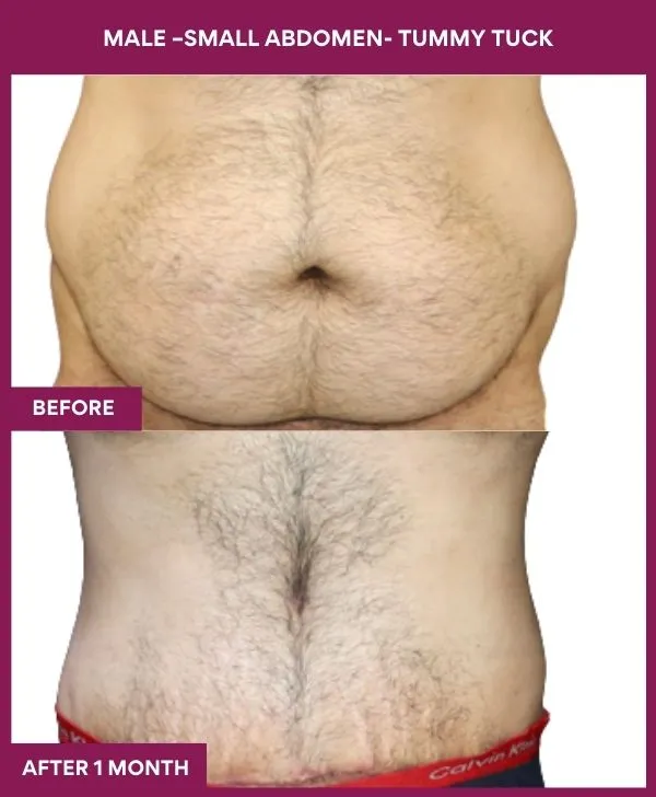 male-small-tummy-tuck-before-after-results-mumbai-india-patient04-front