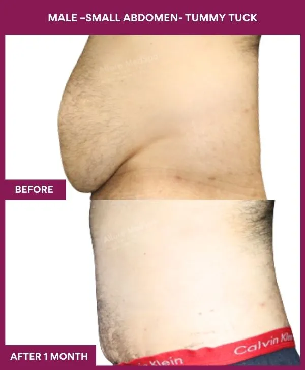 male-small-tummy-tuck-before-after-results-mumbai-india-patient04-side-left