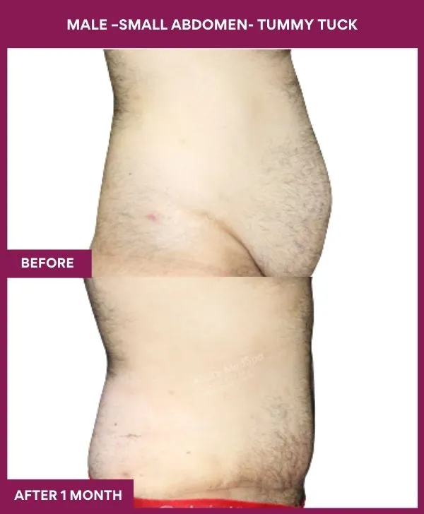 male-small-tummy-tuck-before-after-results-mumbai-india-patient04-side-right
