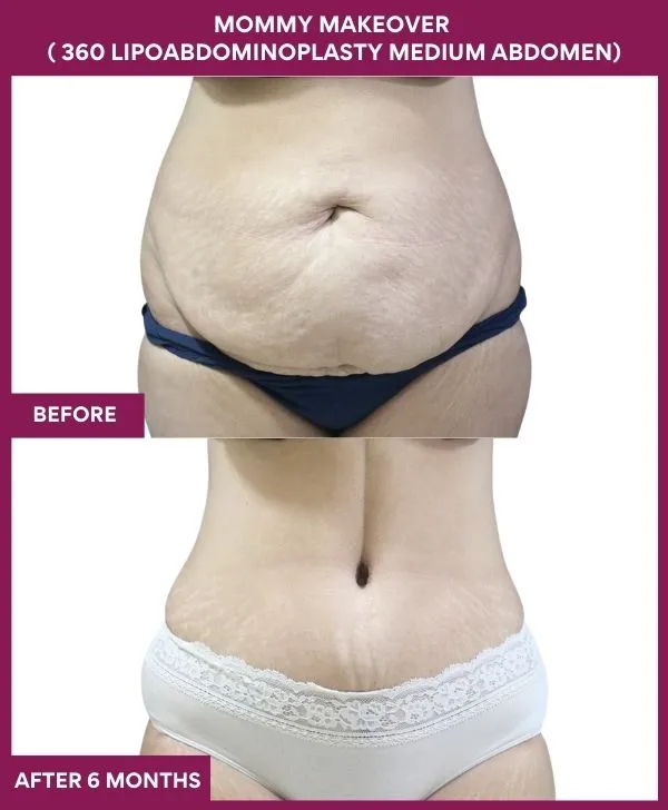 mommy-makeover-360-tummy-tuck-before-after-results-mumbai-india-patient08-front