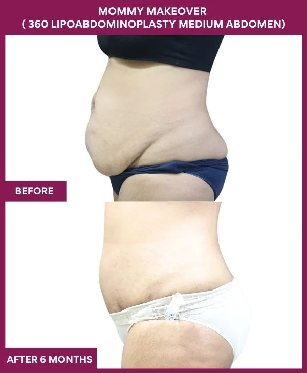 mommy-makeover-360-tummy-tuck-before-after-results-mumbai-india-patient08-side-left