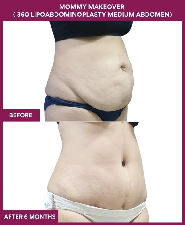 mommy-makeover-360-tummy-tuck-before-after-results-mumbai-india-patient08-side-right
