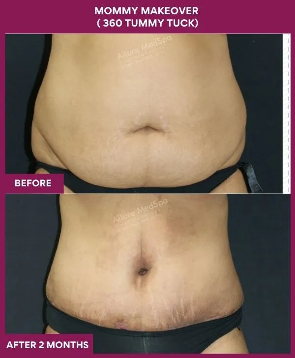 mommy-makeover-360-tummy-tuck-before-after-results-mumbai-india-patient09-front
