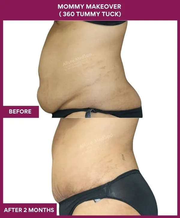 mommy-makeover-360-tummy-tuck-before-after-results-mumbai-india-patient09-side-left